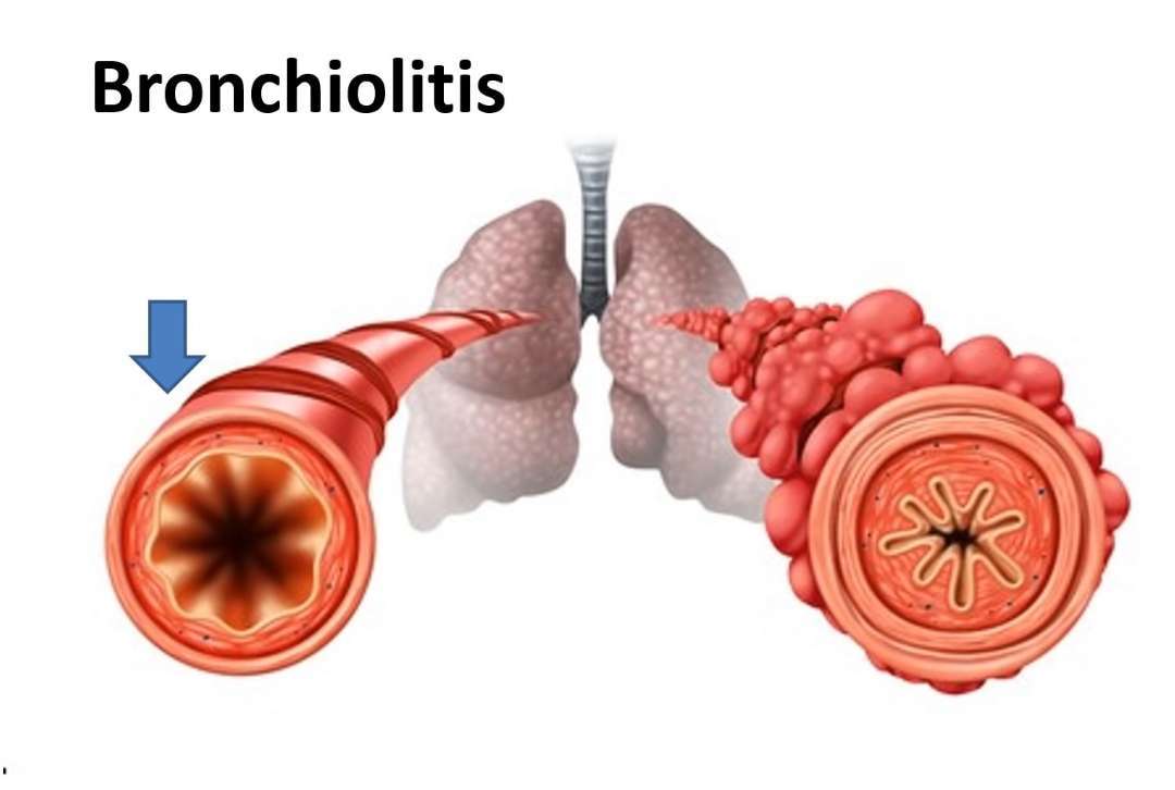 Broncholitic-lung-infection