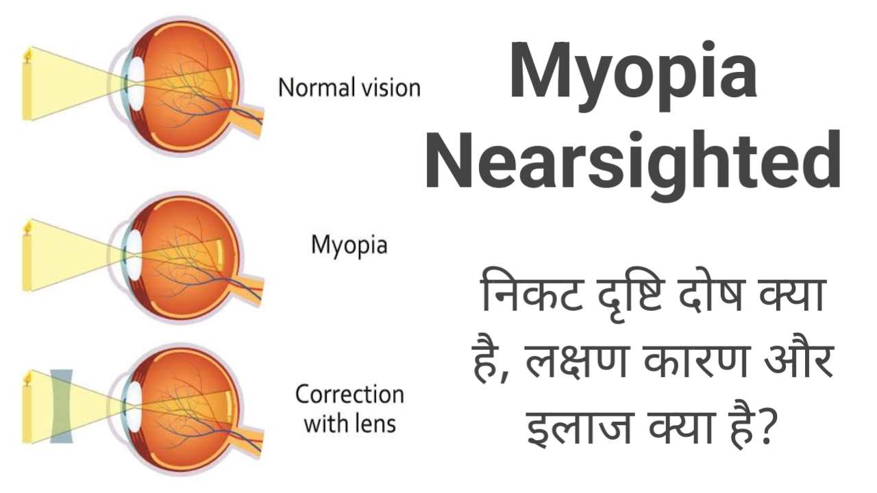 myopia nikat drishti dosh